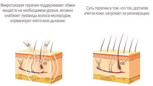 Процедура микротоки_виды Процедура микротоки