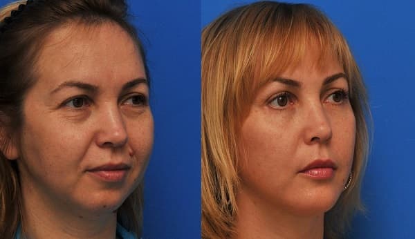 Подтяжка мышц лица_безоперационные методы Подтяжка мышц лица_безоперационные методы