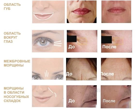 Процедура микротоки_технология Процедура микротоки_технология