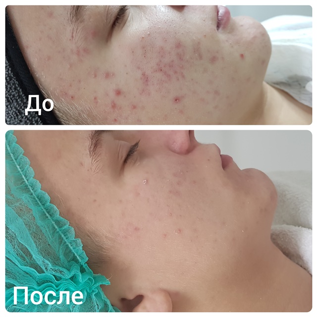 Атравматичная чистка проводится в несколько связанных между собой последовательных этапов