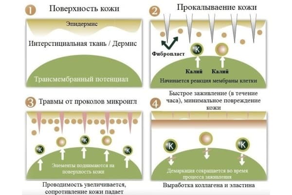Фракционная мезотерапия кожи лица_этапы Фракционная мезотерапия кожи лица_этапы